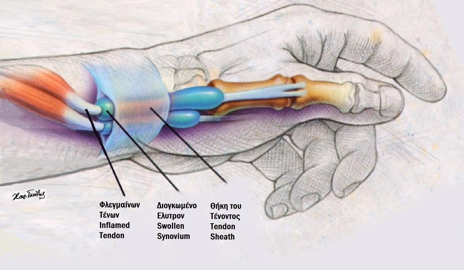 Health Tips De Quervain s Tenosynovitis Canossa Hospital